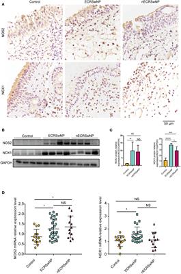 The oxidant-antioxidant imbalance was involved in the pathogenesis of chronic rhinosinusitis with nasal polyps